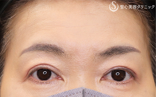 【40代女性・眼瞼下垂を治して若返り】眼瞼下垂（切開法/腱膜縫縮法）（3ヶ月後） After 