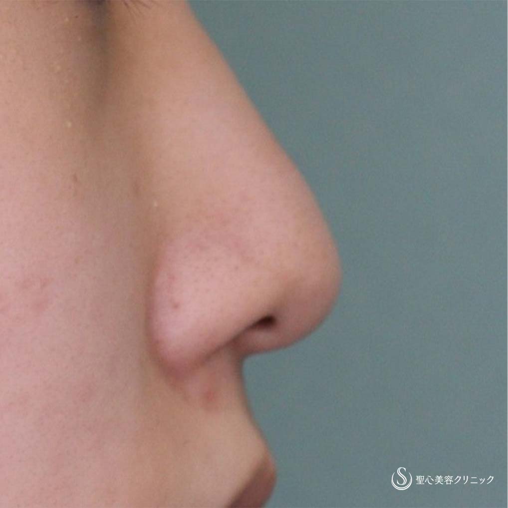 【10代女性・小鼻を小さく】小鼻縮小術（1ヶ月後） Before 