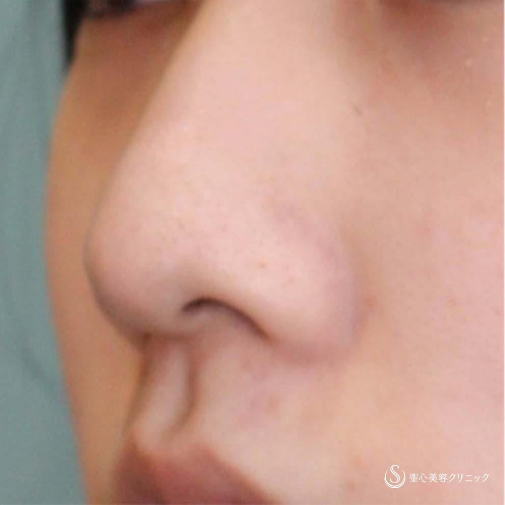 【10代女性・小鼻を小さく】小鼻縮小術（1ヶ月後） Before 