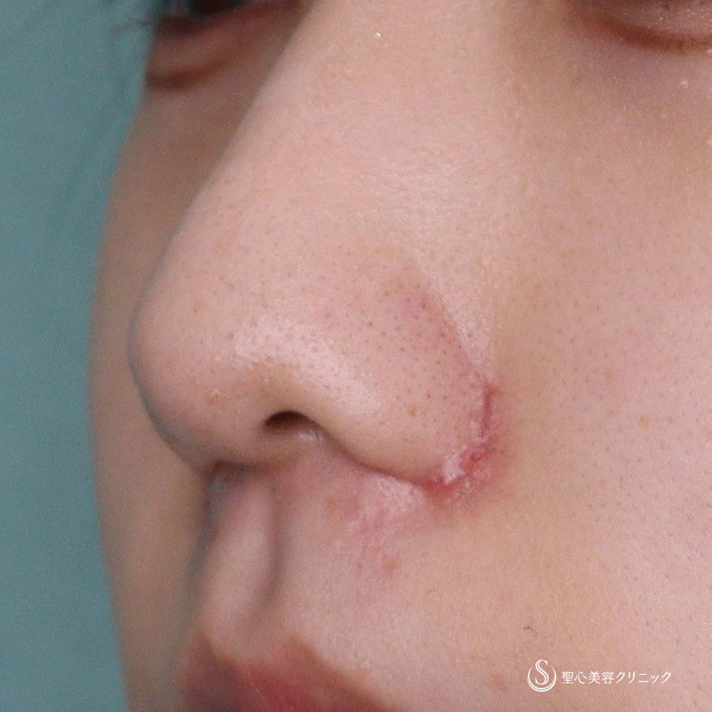 【10代女性・小鼻を小さく】小鼻縮小術（1ヶ月後） After 