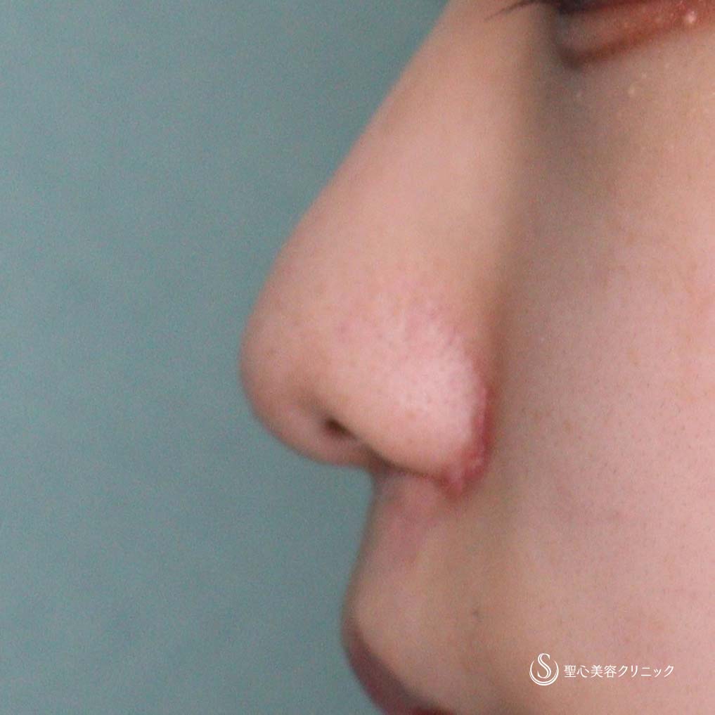 【10代女性・小鼻を小さく】小鼻縮小術（1ヶ月後） After 