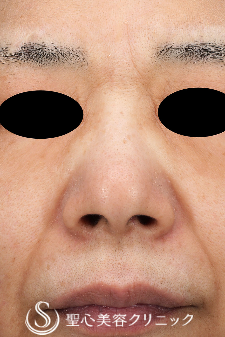 【60代女性・眉間とほうれい線のシワ】プレミアムPRP皮膚再生療法（2年9か月後） Before 