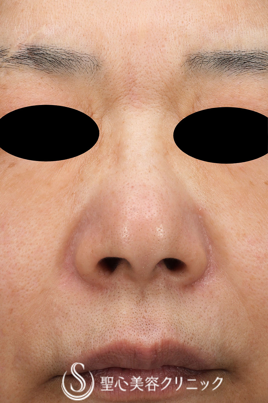 【60代女性・眉間とほうれい線のシワ】プレミアムPRP皮膚再生療法（2年9か月後） After 