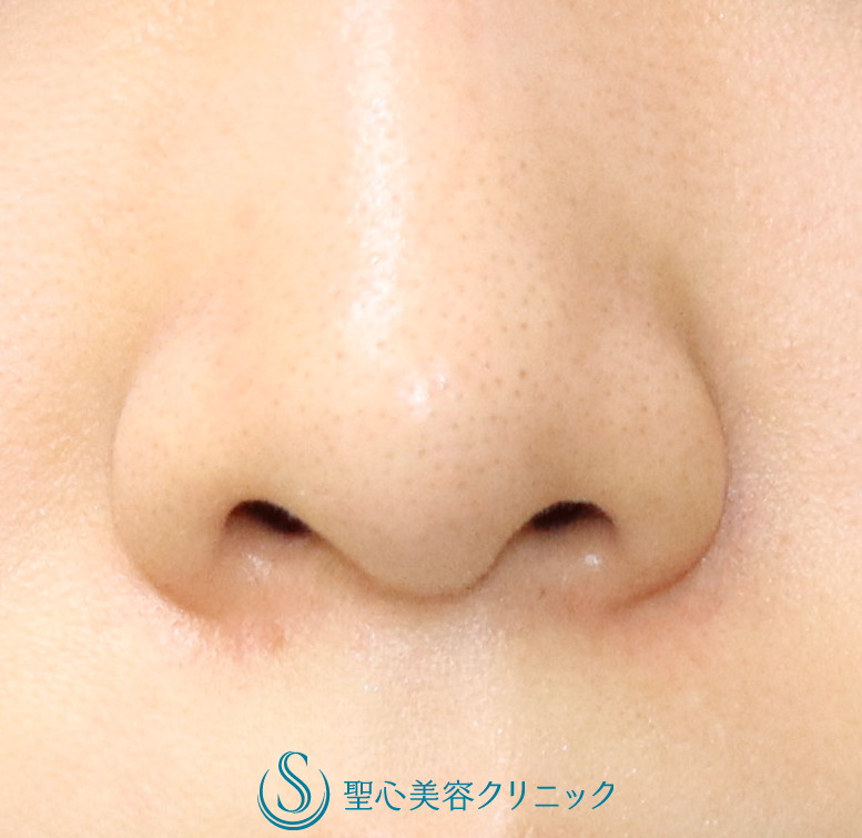 【20代女性・小鼻の丸みの改善】小鼻縮小（2か月後） Before 