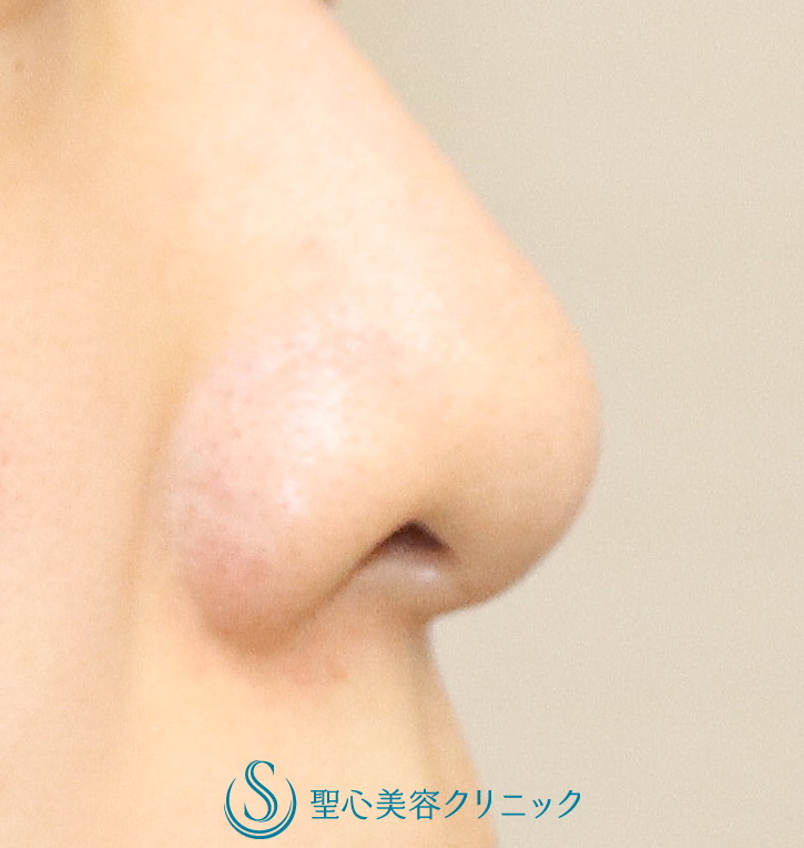 【20代女性・小鼻の丸みの改善】小鼻縮小（2か月後） Before 