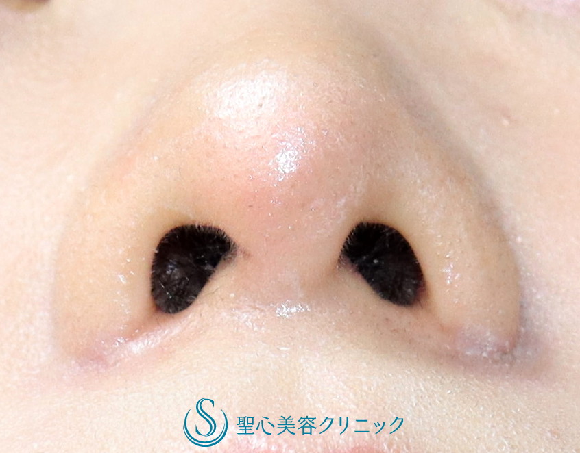 【20代女性・小鼻の丸みの改善】小鼻縮小（2か月後） After 