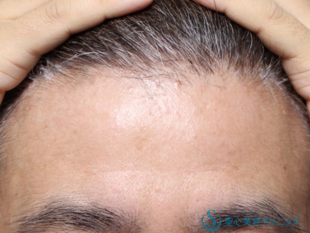 【40代男性・額と眉間をふっくらと】プレミアムＰＲＰ皮膚再生療法（6ヶ月後） Before 