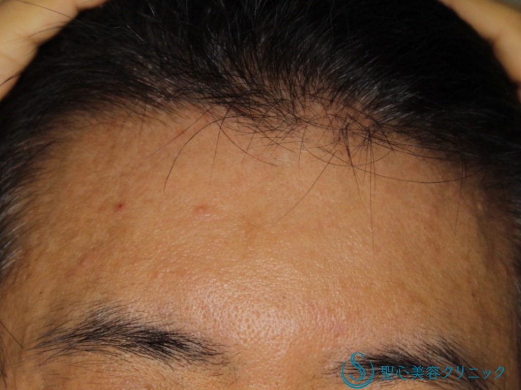 【40代男性・額と眉間をふっくらと】プレミアムＰＲＰ皮膚再生療法（6ヶ月後） After 