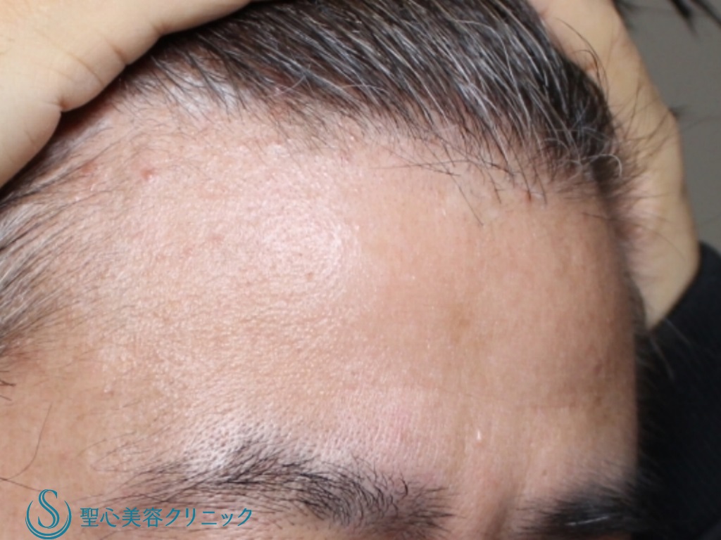 【40代男性・額と眉間をふっくらと】プレミアムＰＲＰ皮膚再生療法（6ヶ月後） Before 