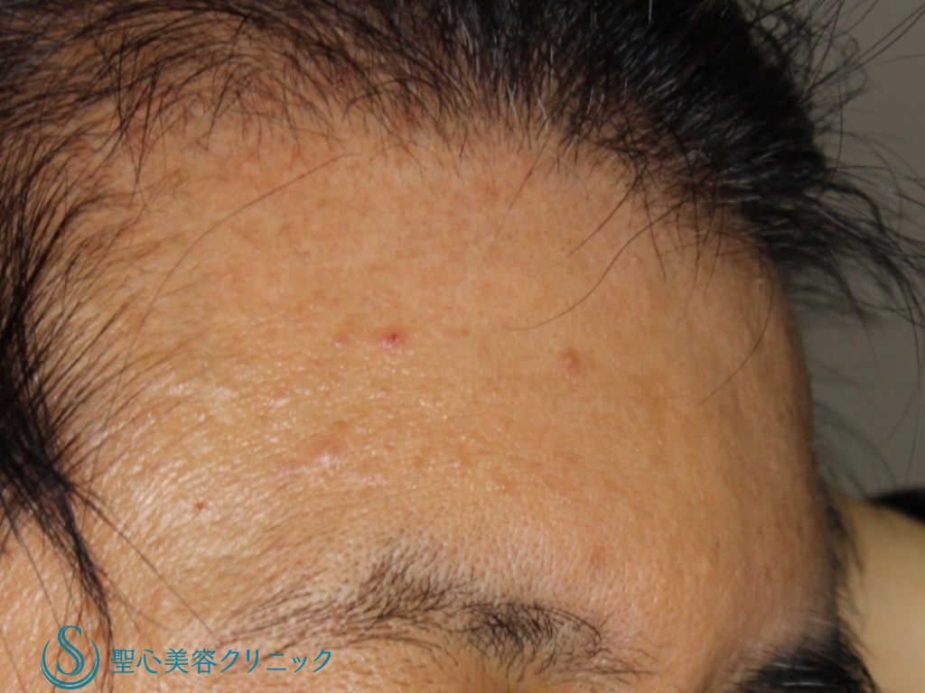 【40代男性・額と眉間をふっくらと】プレミアムＰＲＰ皮膚再生療法（6ヶ月後） After 