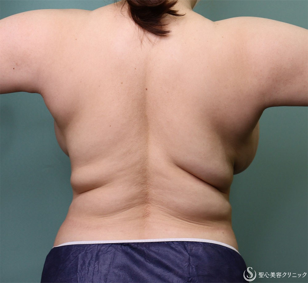 【40代女性・背中痩身】ベイザーリポ2.2脂肪吸引（1ヶ月後） Before 