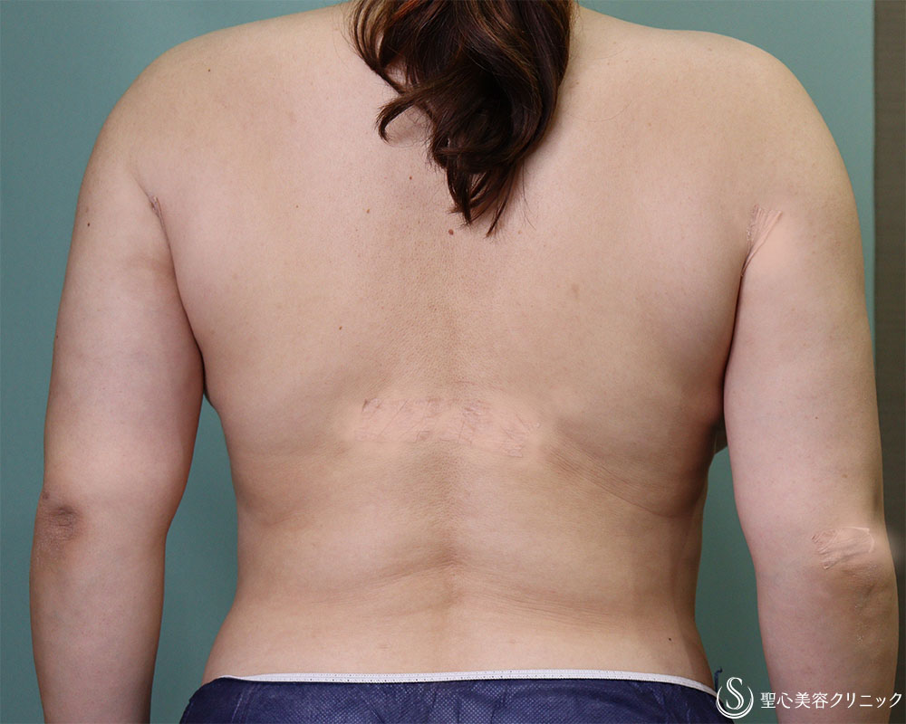 【40代女性・背中痩身】ベイザーリポ2.2脂肪吸引（1ヶ月後） After 