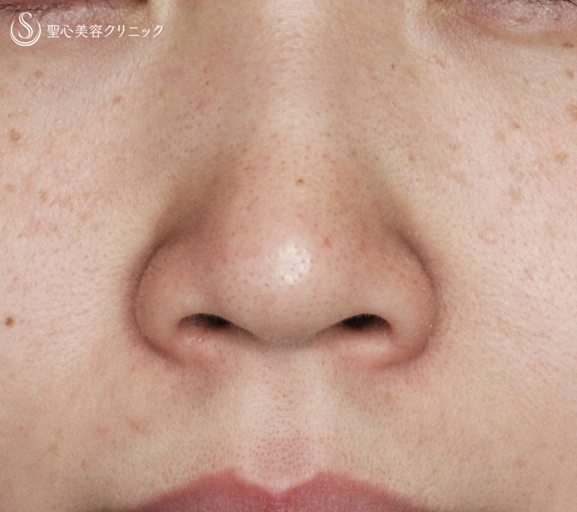 【20代女性・特徴的な小鼻をスマートに】小鼻縮小術+α法（3年半後） Before 