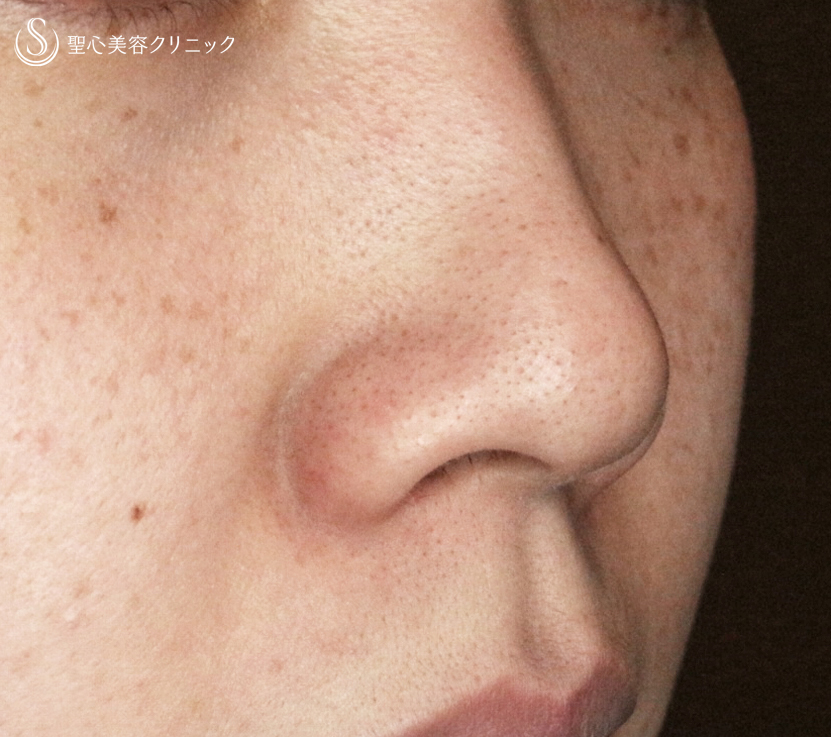 【20代女性・特徴的な小鼻をスマートに】小鼻縮小術+α法（3年半後） Before 
