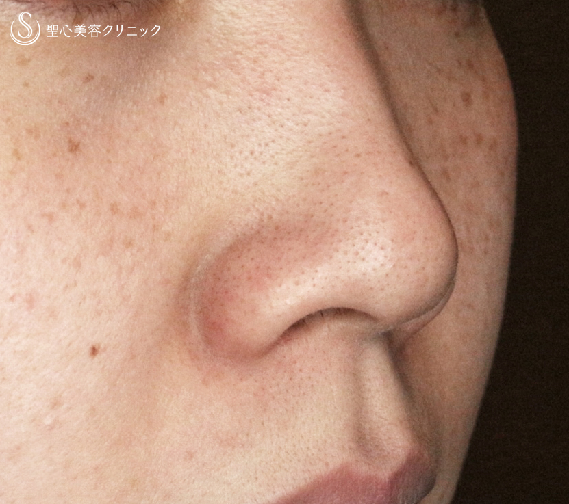 【20代女性・特徴的な小鼻をスマートに】小鼻縮小術+α法（3年半後） Before 