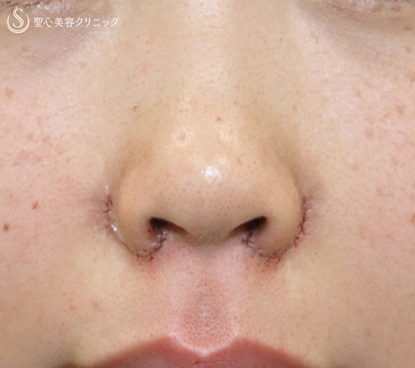 【20代女性・特徴的な小鼻をスマートに】小鼻縮小術+α法（3年半後） After 