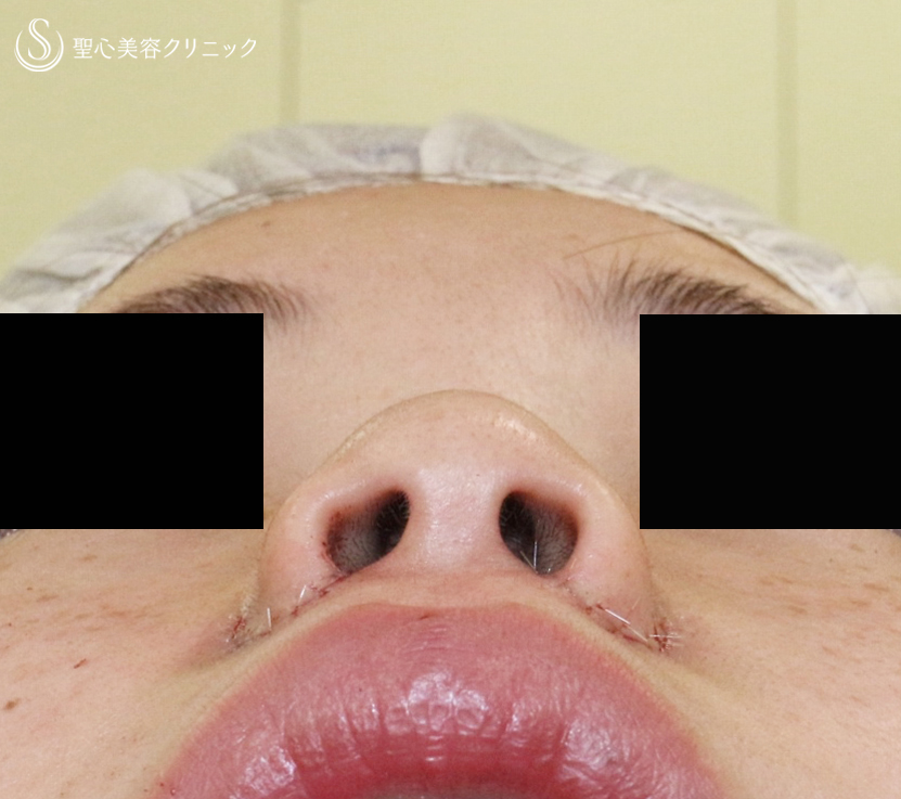 【20代女性・特徴的な小鼻をスマートに】小鼻縮小術+α法（3年半後） After 