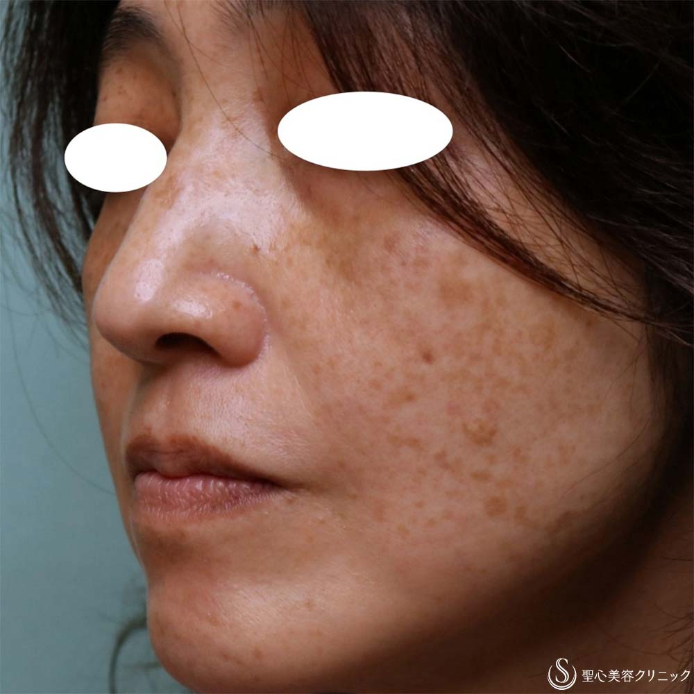 【50代女性・目の下＆ほうれい線】プレミアムPRP皮膚再生療法（2ヶ月・6ヶ月・8ヶ月） Before 