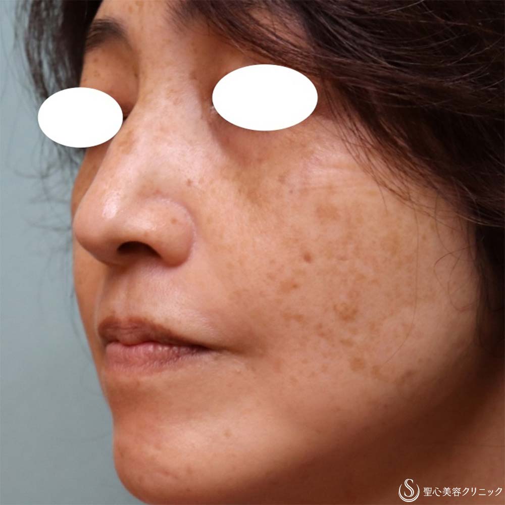 【50代女性・目の下＆ほうれい線】プレミアムPRP皮膚再生療法（2ヶ月・6ヶ月・8ヶ月） Before 