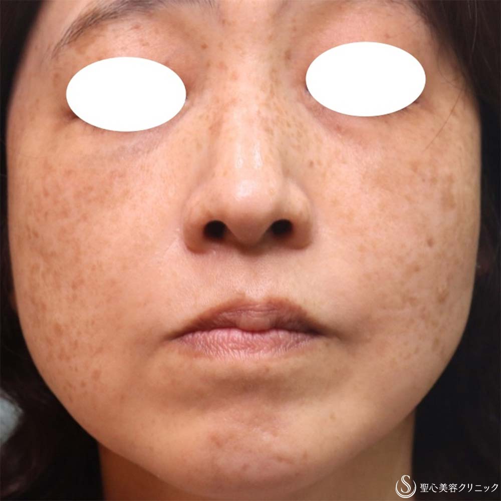 【50代女性・目の下＆ほうれい線】プレミアムPRP皮膚再生療法（2ヶ月・6ヶ月・8ヶ月） After 