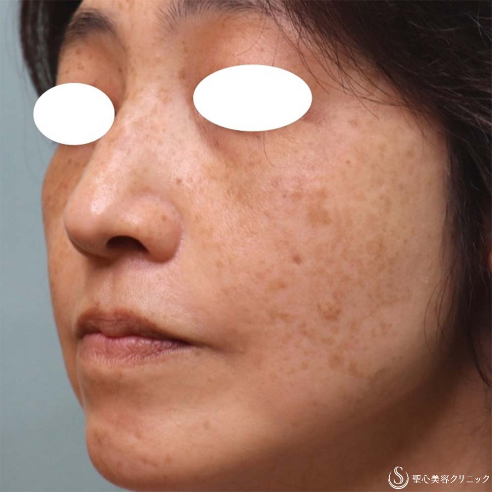 【50代女性・目の下＆ほうれい線】プレミアムPRP皮膚再生療法（2ヶ月・6ヶ月・8ヶ月） After 