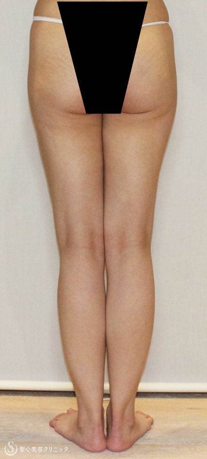 【20代女性・自然なバスト＆美脚】プレミアム・セリューション豊胸術（6ヶ月後） After 