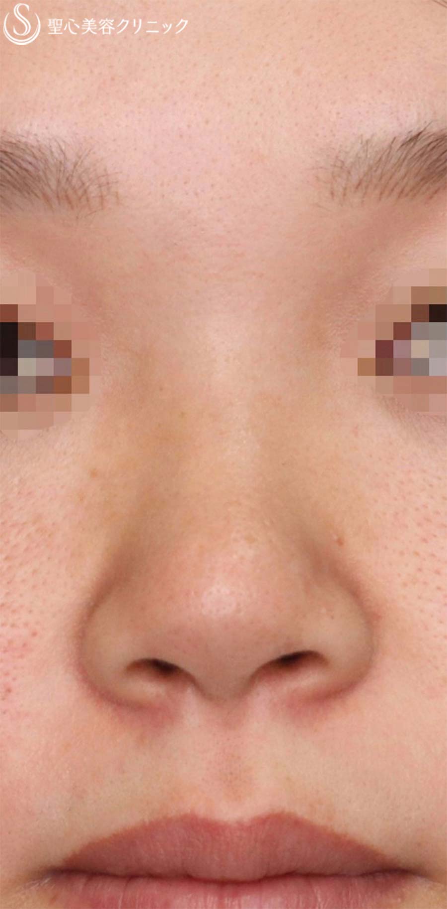 【20代女性・お鼻を高くスッキリ！！】プロテーゼ＋鼻尖縮小＋鼻尖形成（耳介軟骨移植）（1ヶ月半後） Before 