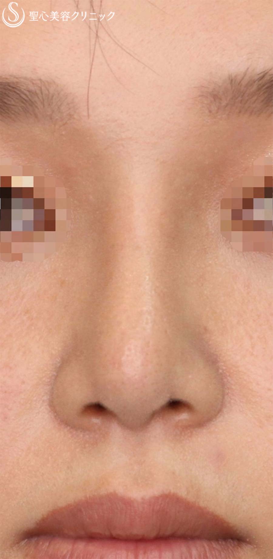 【20代女性・お鼻を高くスッキリ！！】プロテーゼ＋鼻尖縮小＋鼻尖形成（耳介軟骨移植）（1ヶ月半後） After 