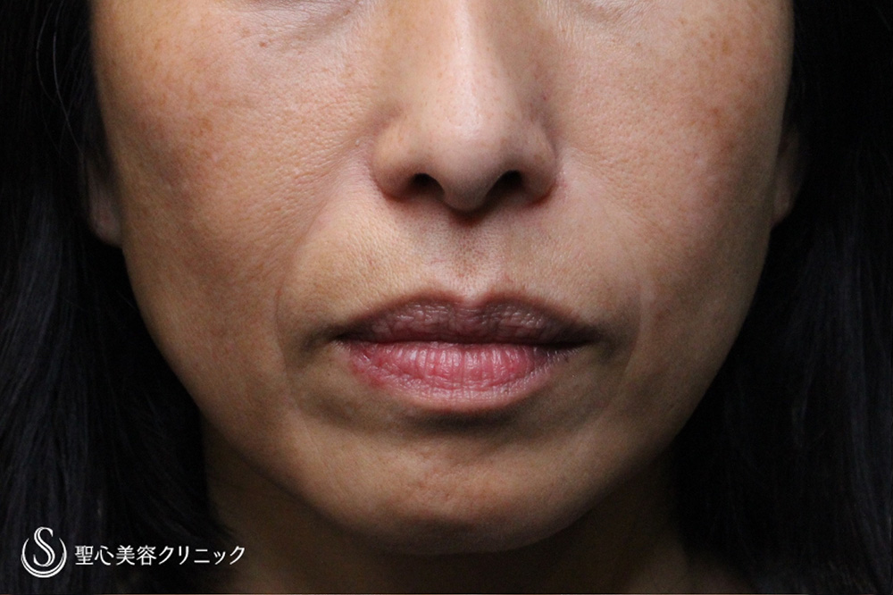 【40代女性・法令線、マリオネットライン】プレミアムPRP皮膚再生療法（1.5年後） Before 