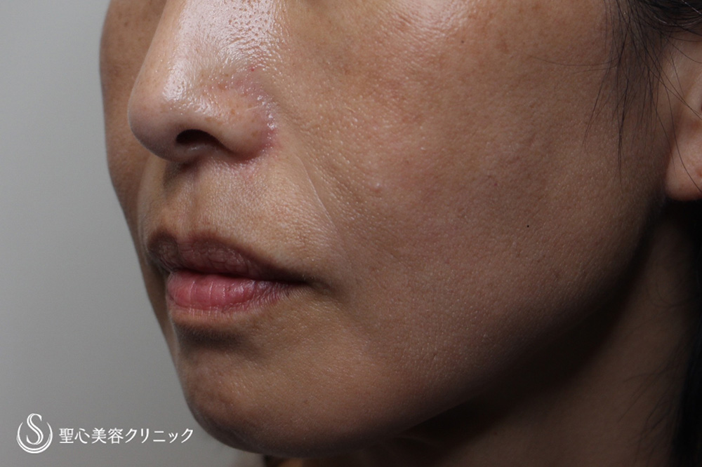 【40代女性・法令線、マリオネットライン】プレミアムPRP皮膚再生療法（1.5年後） After 