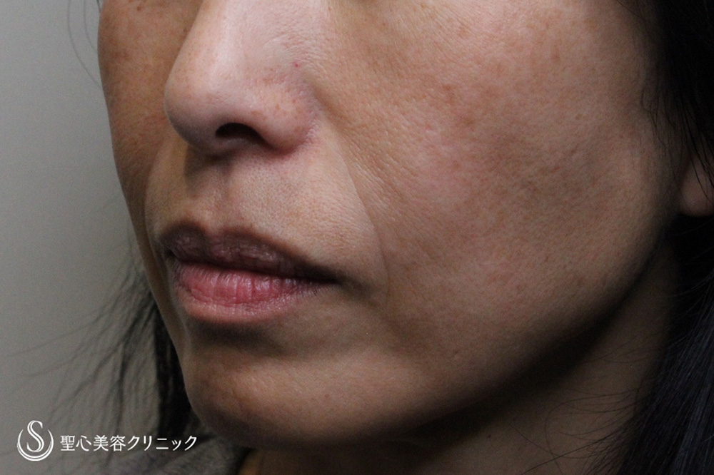 【40代女性・法令線、マリオネットライン】プレミアムPRP皮膚再生療法（1.5年後） Before 