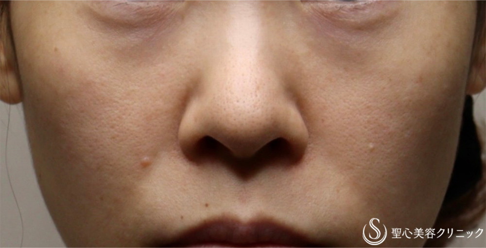 【30代女性・切らない目の下の若返り！！】プレミアムPRP皮膚再生療法（2ヶ月後） Before 