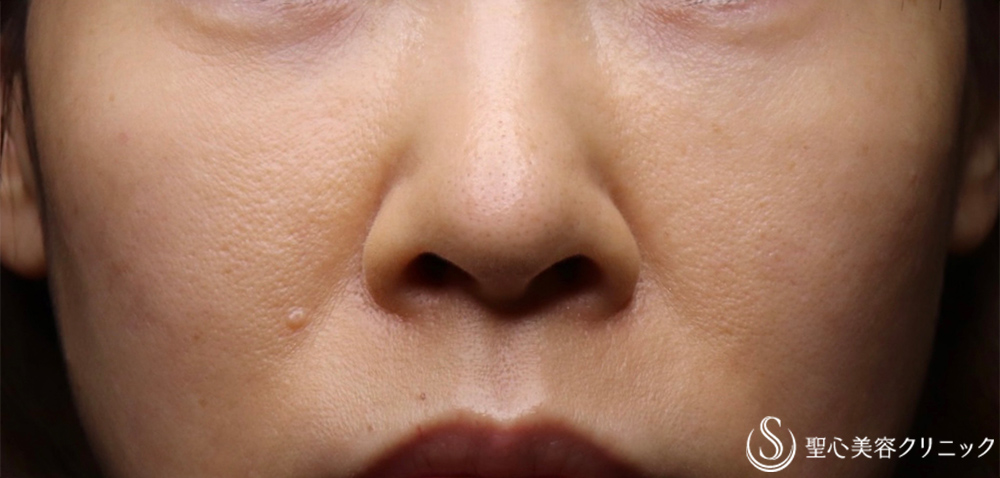 【30代女性・切らない目の下の若返り！！】プレミアムPRP皮膚再生療法（2ヶ月後） After 