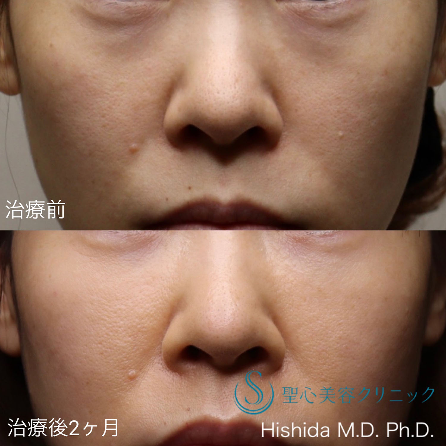 【30代女性・切らない目の下の若返り！！】プレミアムPRP皮膚再生療法（2ヶ月後） After 
