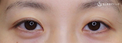 眼瞼下垂（腱膜縫縮法）