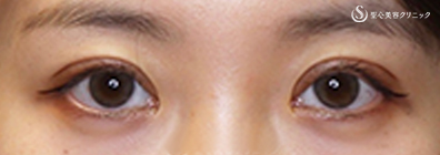眼瞼下垂（腱膜縫縮法）