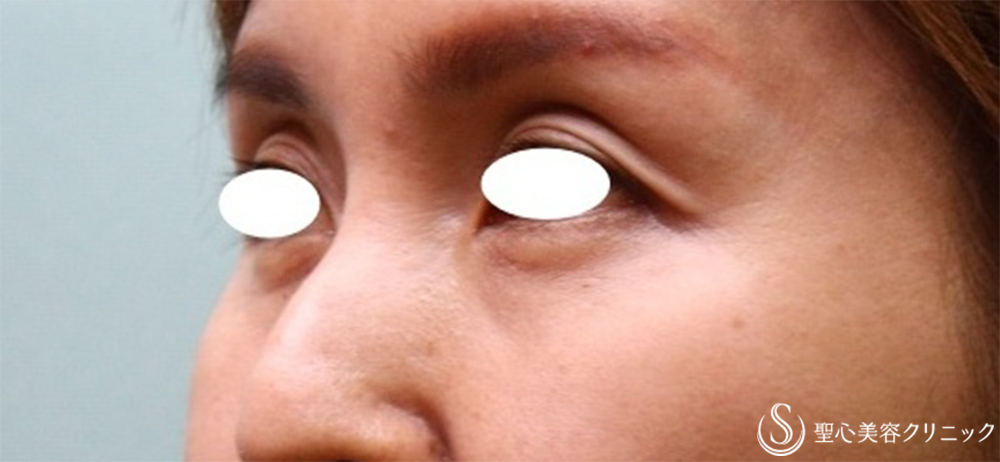 【40代女性・目の上と目の下】プレミアムPRP皮膚再生療法（3か月後） Before 