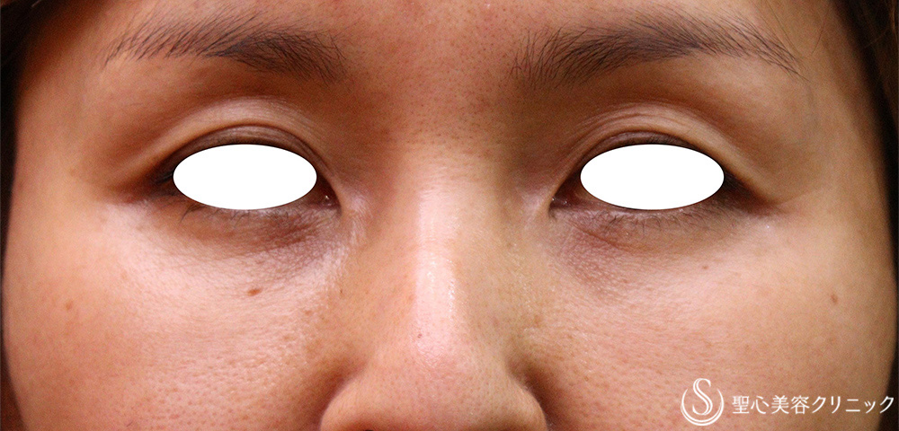 【40代女性・目の上と目の下】プレミアムPRP皮膚再生療法（3か月後） After 