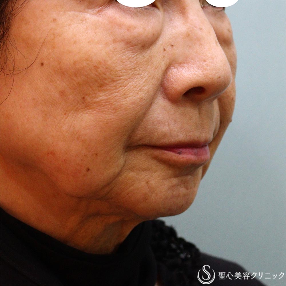 【70代女性・目の下ほうれい線マリオネットライン】プレミアムPRP皮膚再生療法（3か月、９か月後） After 