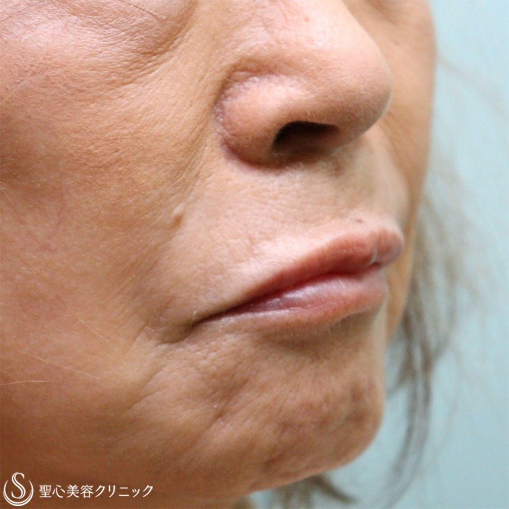 【60代女性・ほうれい線と口上（鼻下）】プレミアムPRP皮膚再生療法（1.5か月後） Before 
