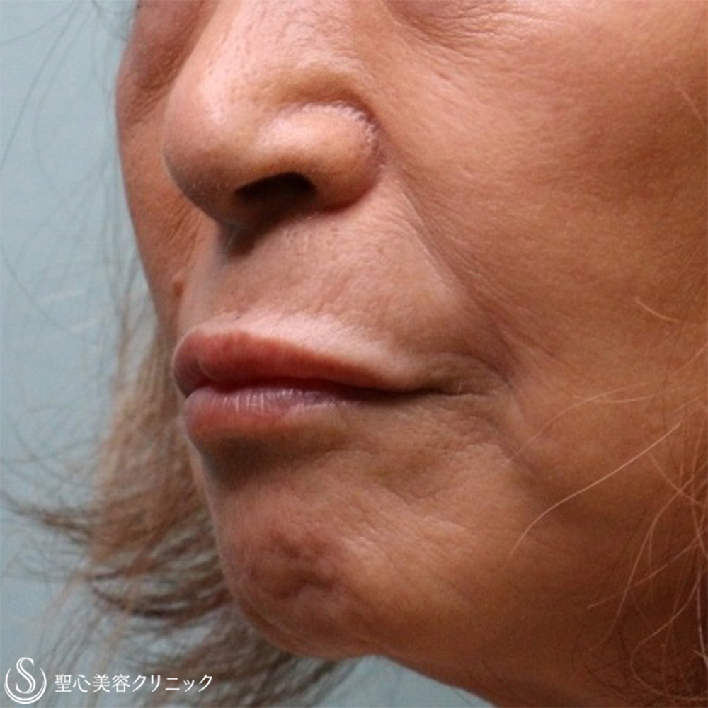 【60代女性・ほうれい線と口上（鼻下）】プレミアムPRP皮膚再生療法（1.5か月後） Before 