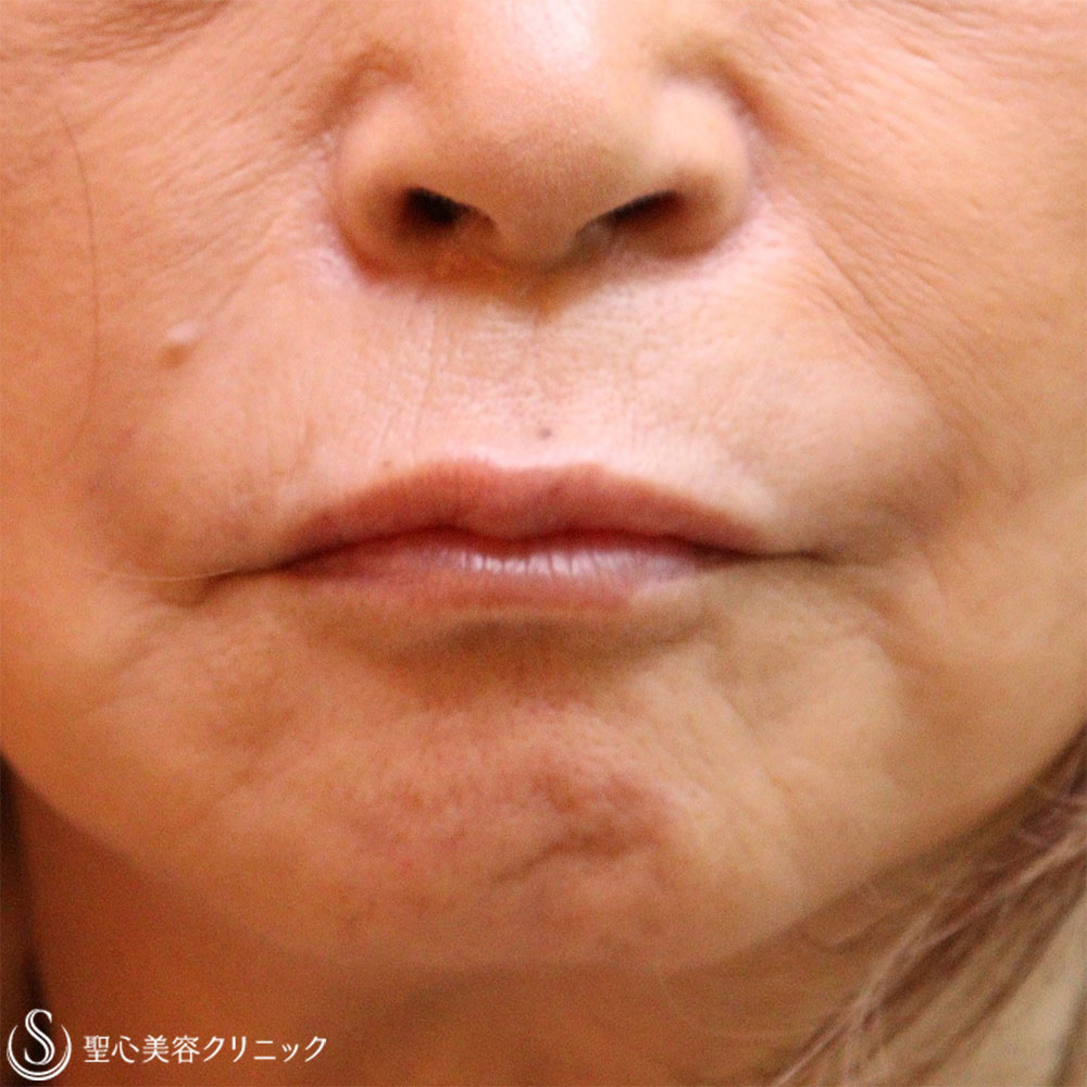 【60代女性・ほうれい線と口上（鼻下）】プレミアムPRP皮膚再生療法（1.5か月後） After 