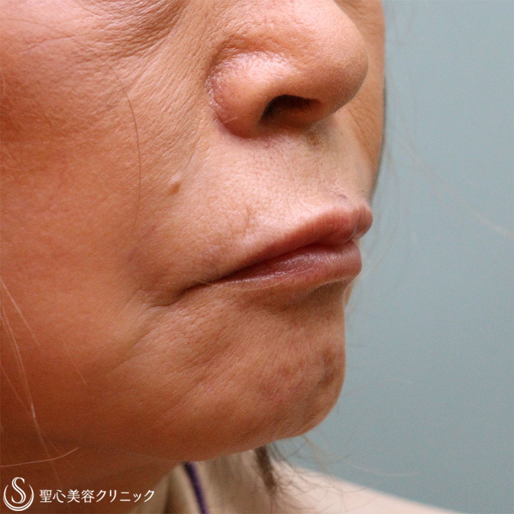 【60代女性・ほうれい線と口上（鼻下）】プレミアムPRP皮膚再生療法（1.5か月後） After 