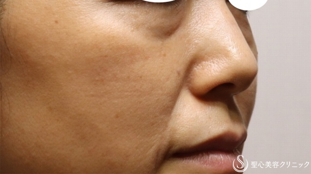 【40代女性・目の下ほうれい線】プレミアムPRP皮膚再生療法（2か月後） Before 