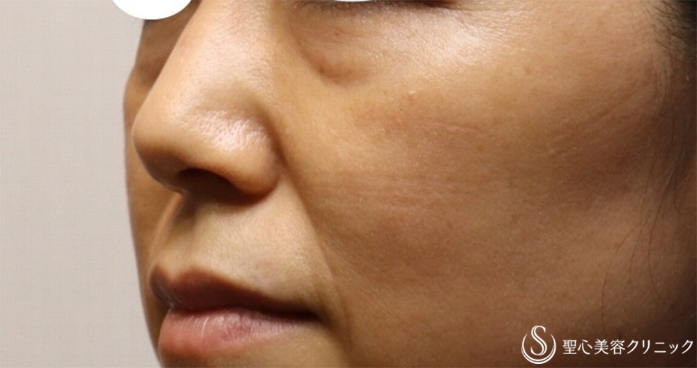 【40代女性・目の下ほうれい線】プレミアムPRP皮膚再生療法（2か月後） Before 