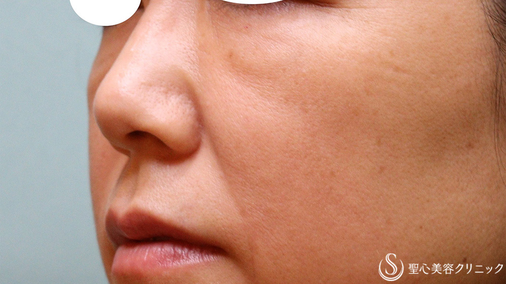 【40代女性・目の下ほうれい線】プレミアムPRP皮膚再生療法（2か月後） After 