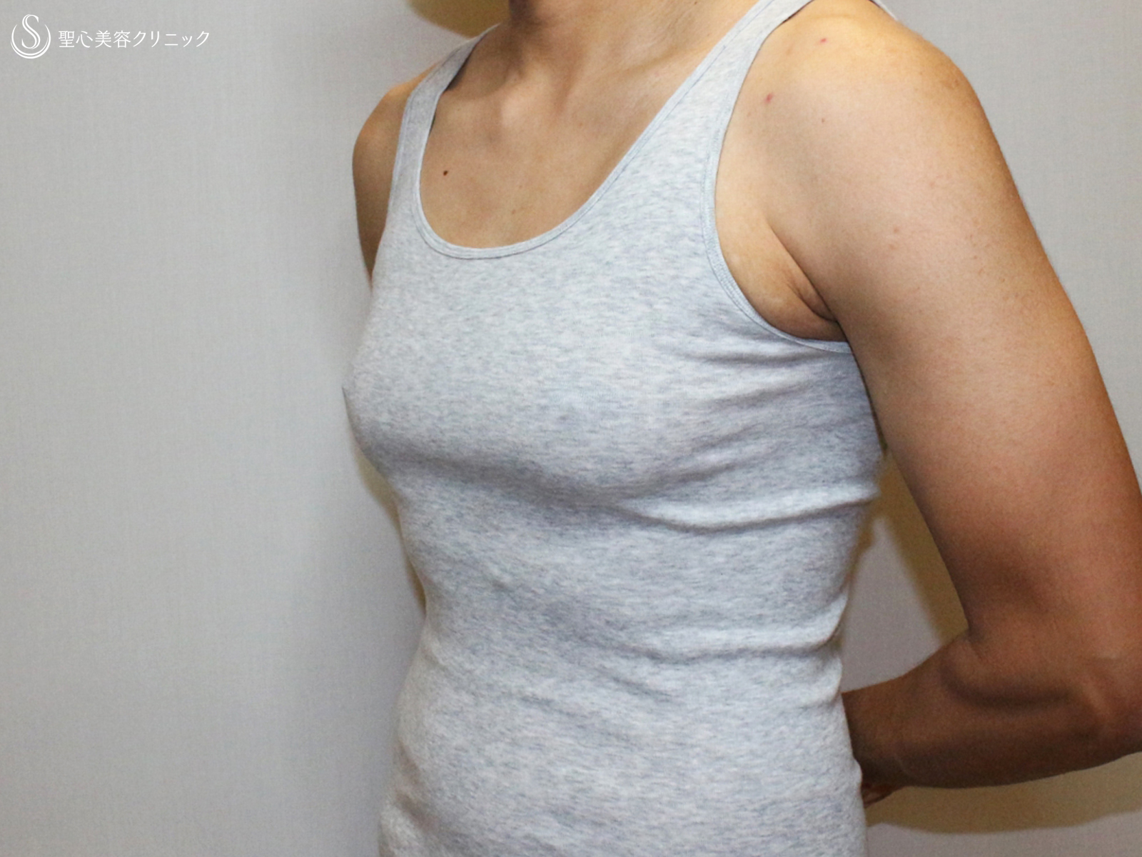 【30代女性・性同一性障害（FTM）男らしい胸にする】乳腺切除術+脂肪吸引（1ヶ月後） Before 