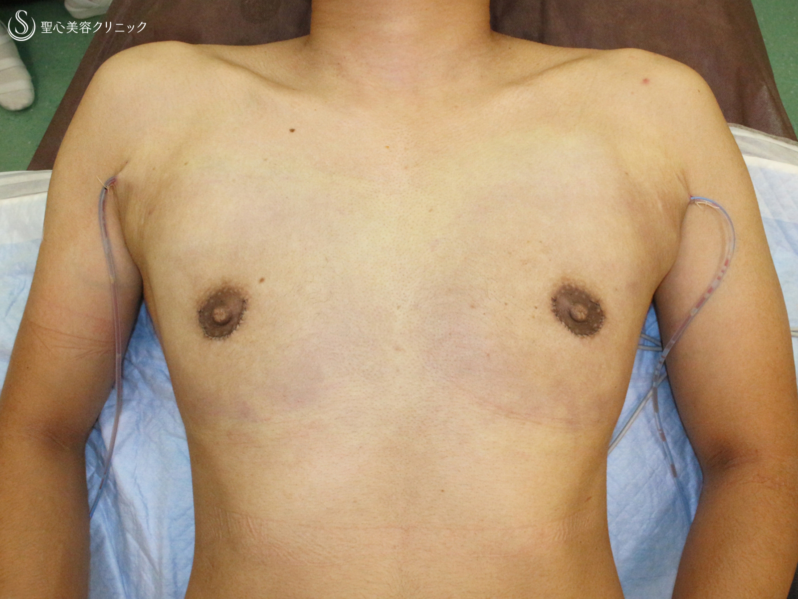 【30代女性・性同一性障害（FTM）男らしい胸にする】乳腺切除術+脂肪吸引（1ヶ月後） After 