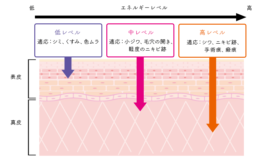 低レベル 適応：シミ、くすみ、色ムラ 中レベル 適応：小ジワ、毛穴の開き、軽度のニキビ跡 高レベル 適応：シワ、ニキビ跡、手術跡、瘢痕