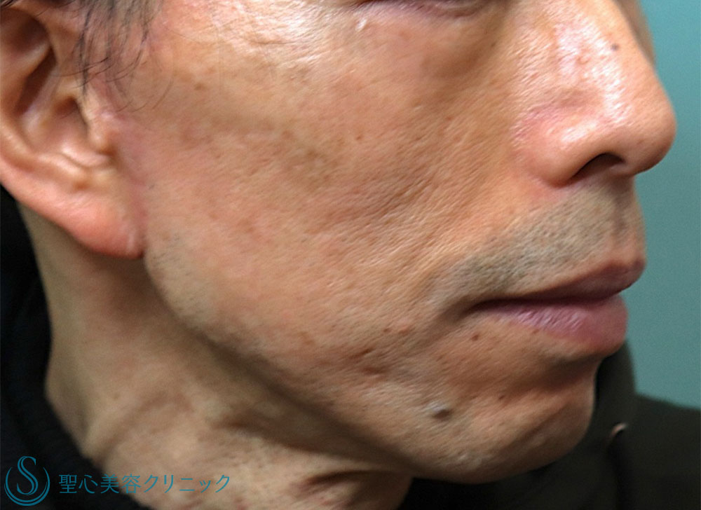 【50代男性・目の下の弛み改善】経結膜下脱脂法＋プレミアムPRP皮膚再生療法（1ヶ月後・1年後） Before 